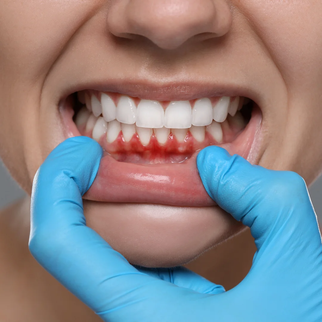 Gum disease treatment at Glendale Dental Wellness