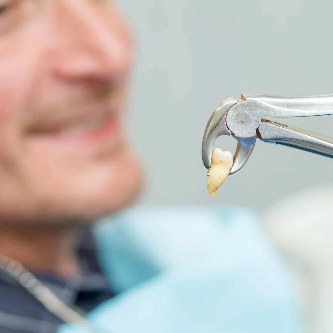 Extractions & Bone Graft