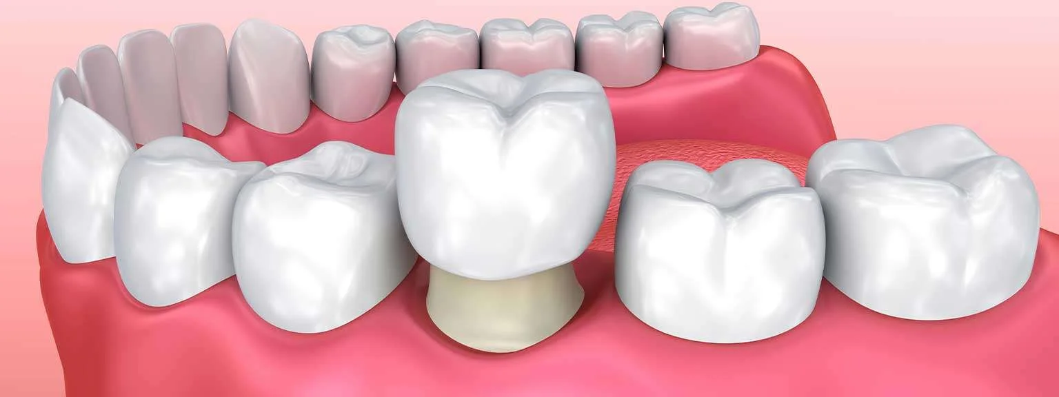 Improve Your Smile's Esthetics with Cosmetic Dental Crowns
