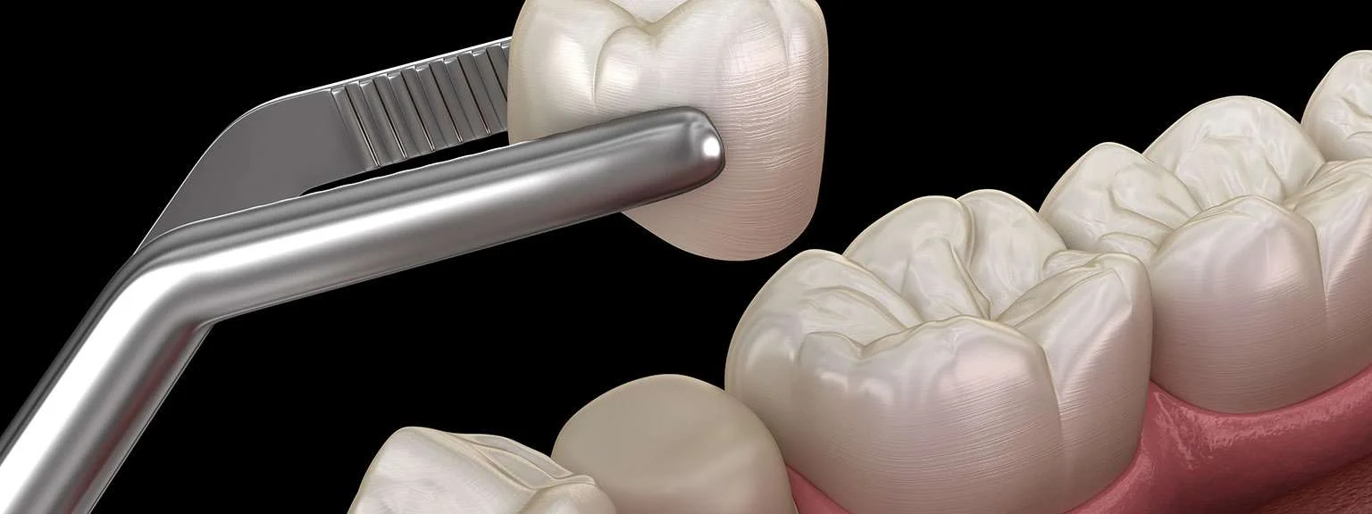 Damaged Front Tooth? Recreate Your Smile with a Porcelain Crown