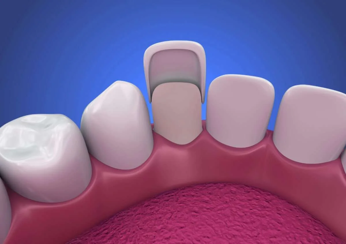 Common Signs That It Is Time to Replace Your Veneers