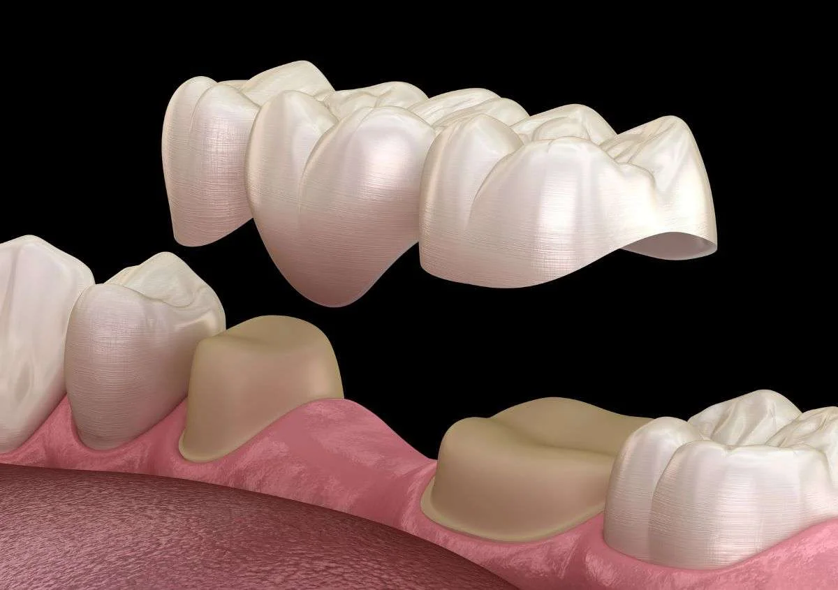 What Causes Dental Implants to Feel Sensitive?
