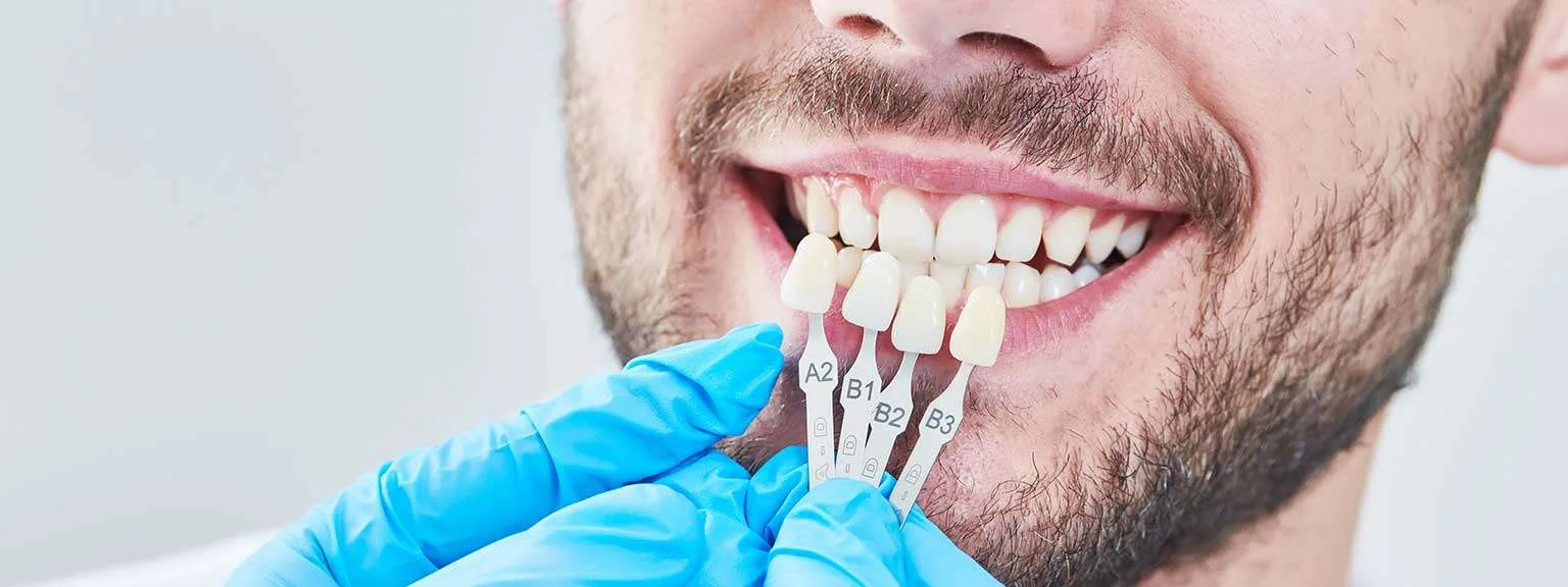 Transform Your Smile This Summer: Professional Veneers for a Smile Makeover 