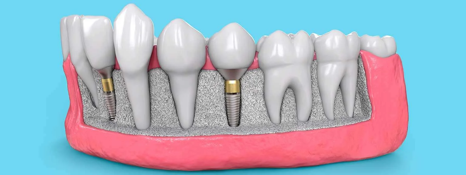 Preparing for Dental Implants: Top Tips To Follow For A Smooth Procedure 